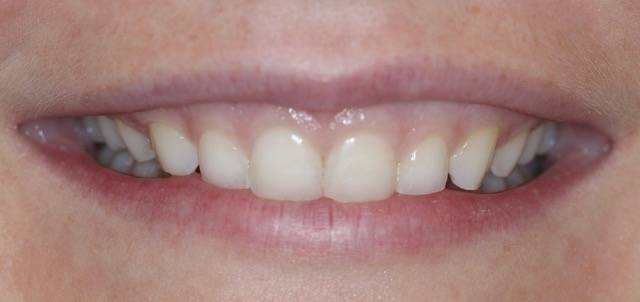 crown length c1 1