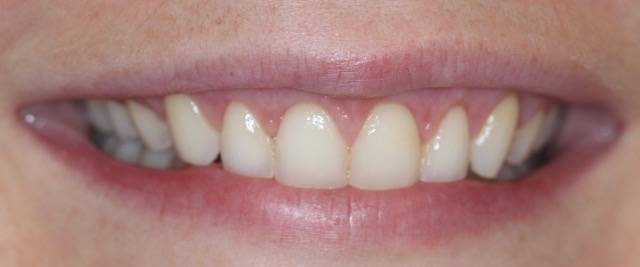 crown length c1 2