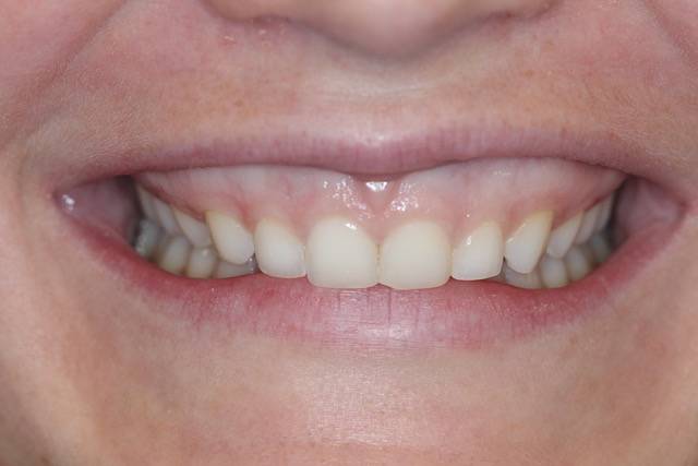 crown length c1 4