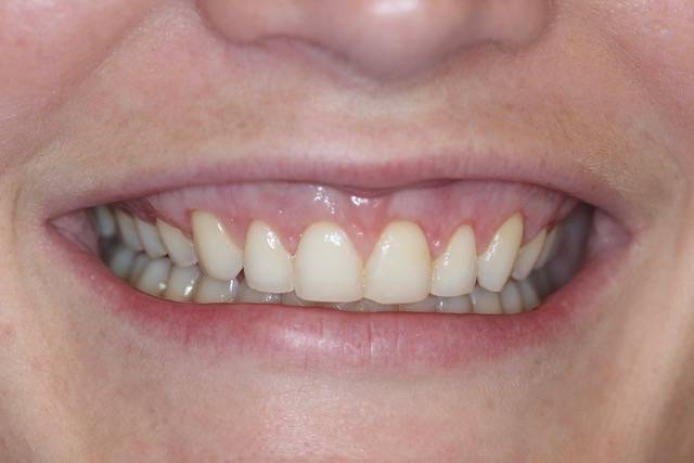 crown length c1 5