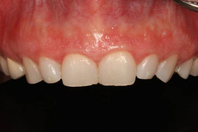 crown length c4 1