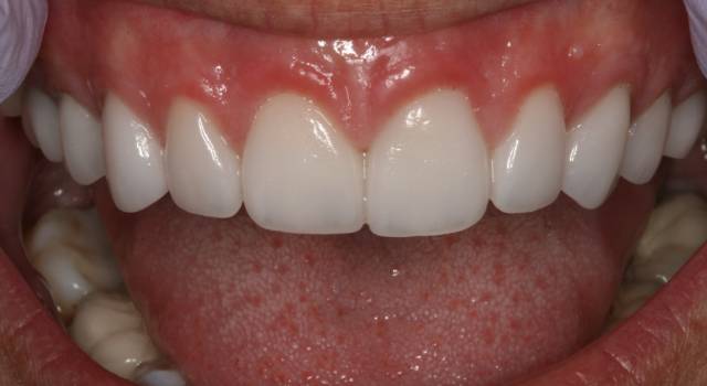 crown length c4 2