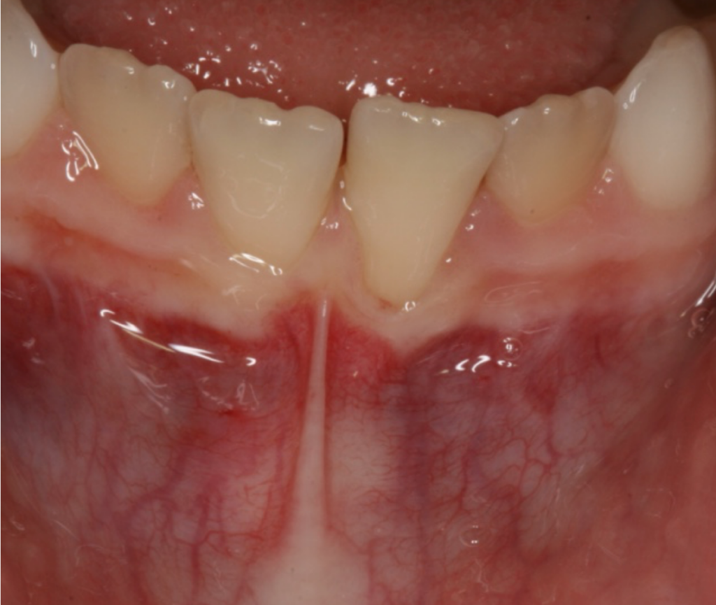 frenectomy c1 1