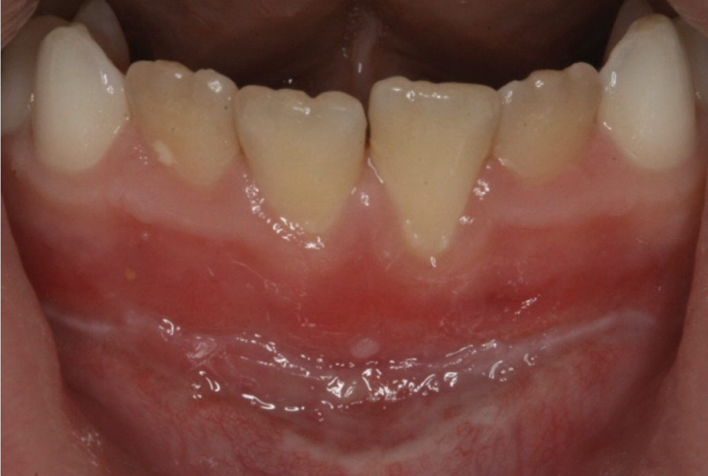frenectomy c1 2