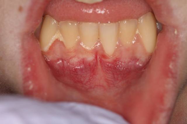 frenectomy c2 1