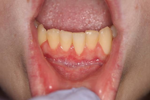 frenectomy c2 2