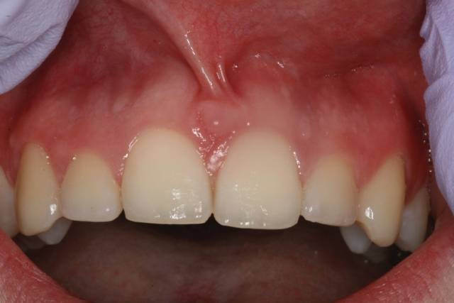 frenectomy c3 1