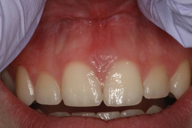 frenectomy c3 2
