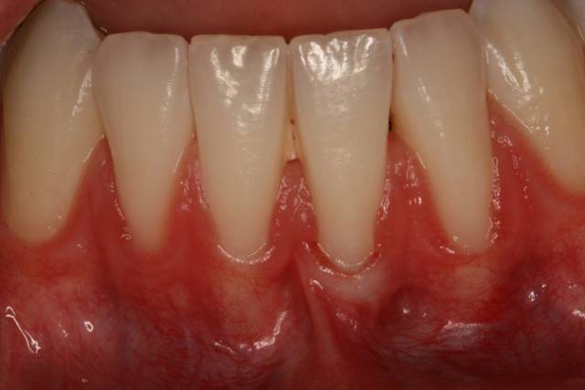 gingival graft c2 1
