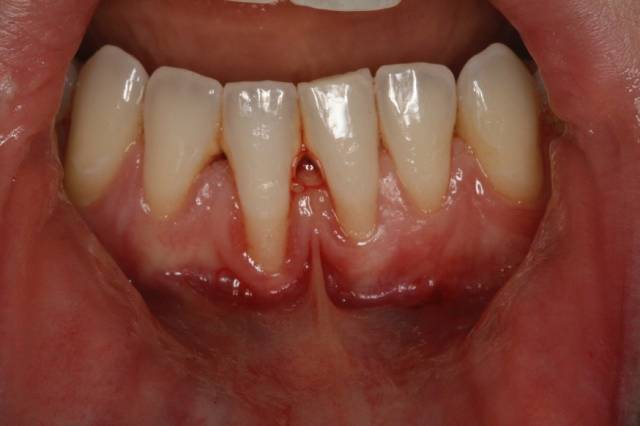 gingival graft c3 1
