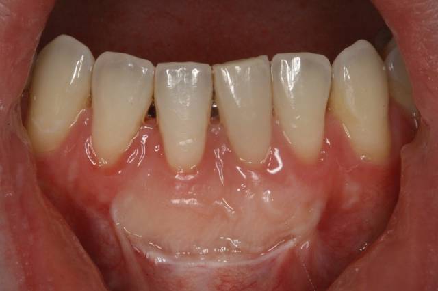 gingival graft c3 2