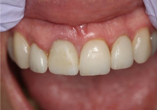 implant c2 after