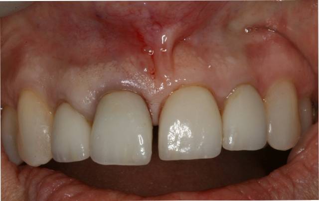 implant c2 before