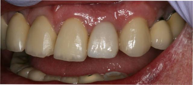 implant c3 temporary