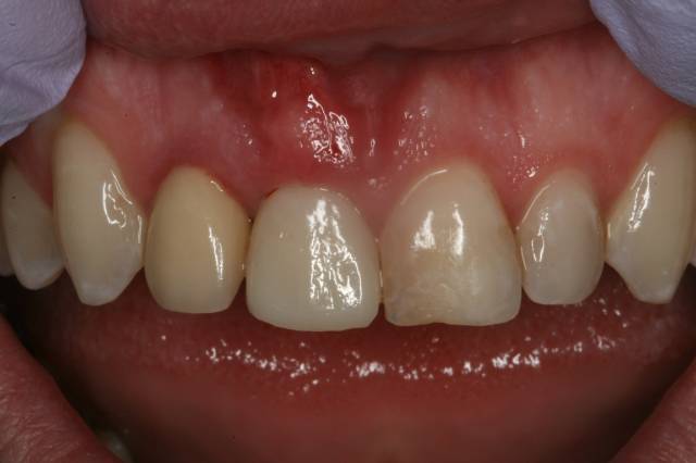implant c4 after