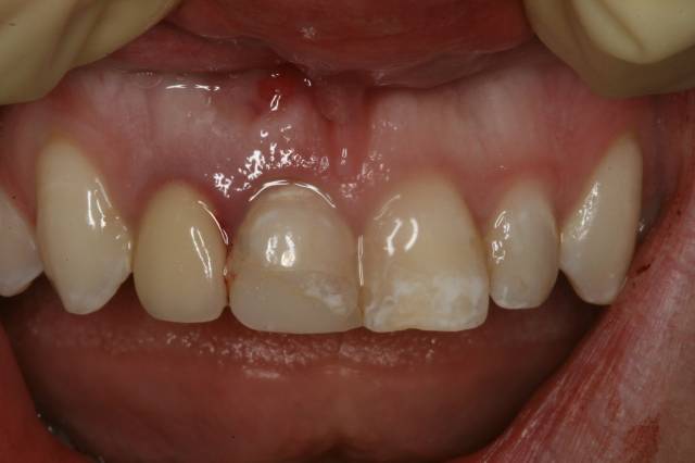 implant c4 before