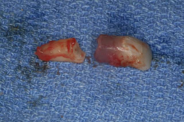 implant c4 tooth fracture