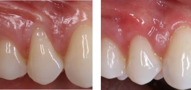 palatal con c2 1