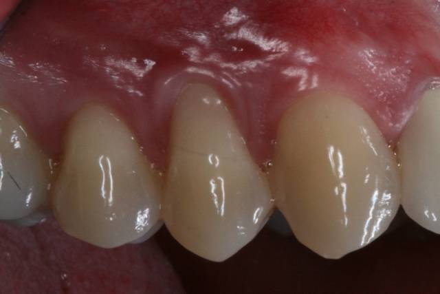palatal con c3 1