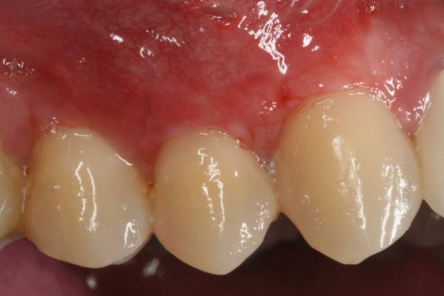 palatal con c3 2