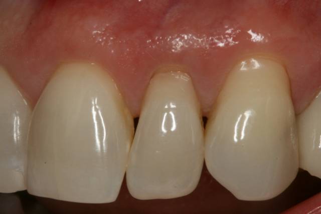 palatal con c4 1