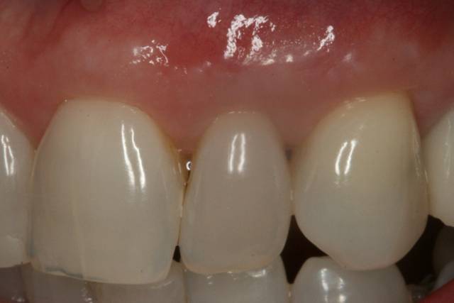 palatal con c4 2