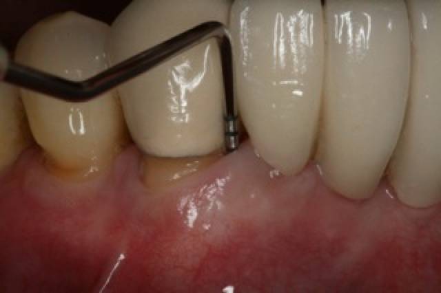 peri graft c1 1