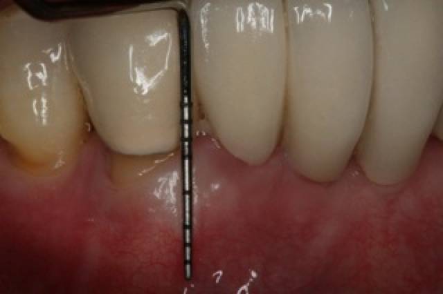 peri graft c1 2