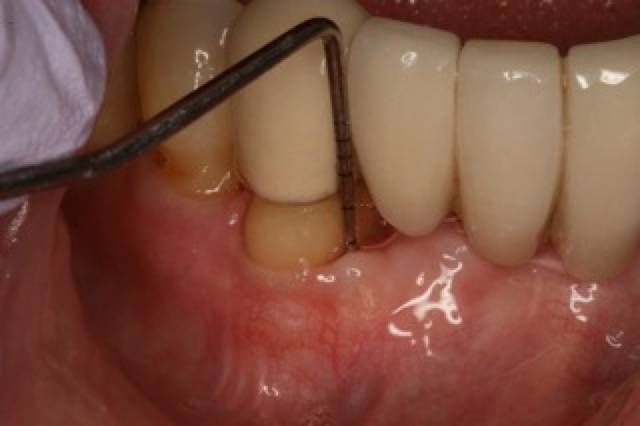 peri graft c1 4