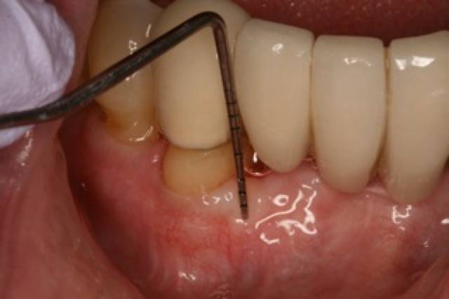 peri graft c1 5