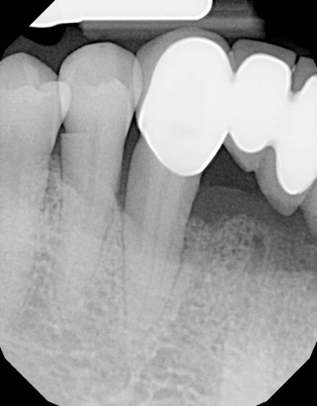 peri graft c1 6