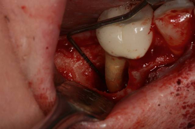 peri graft c2 1