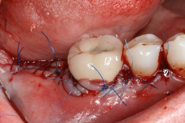 peri graft c2 3