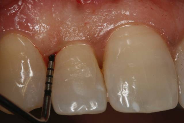 peri graft c3 1