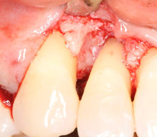 peri graft c3 2