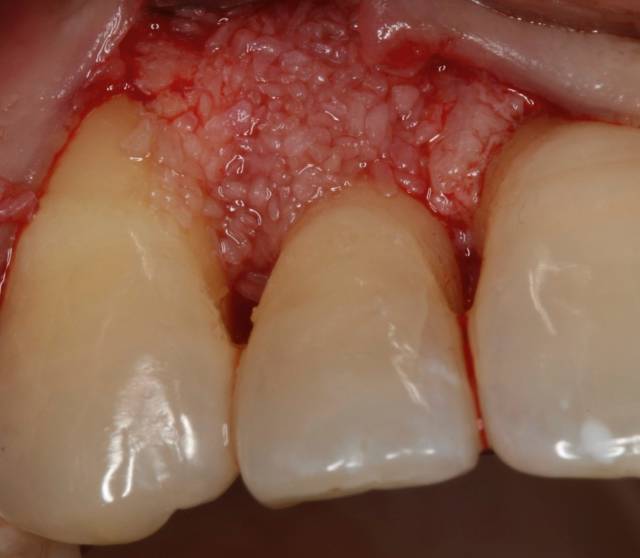 peri graft c3 3