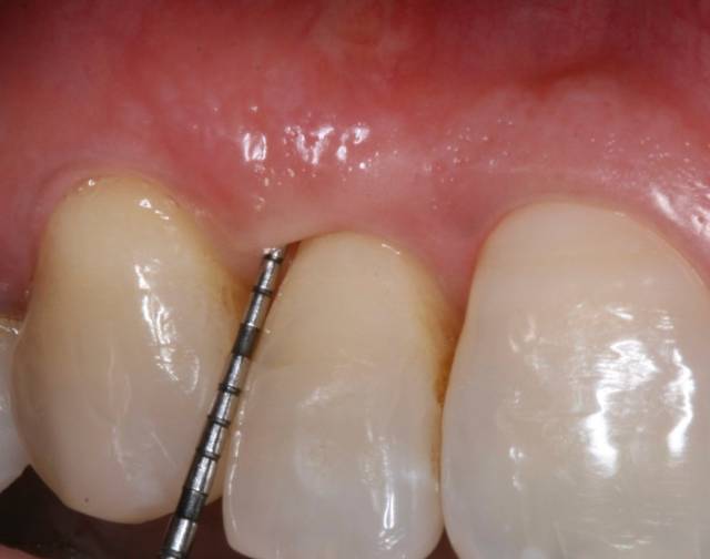 peri graft c3 4