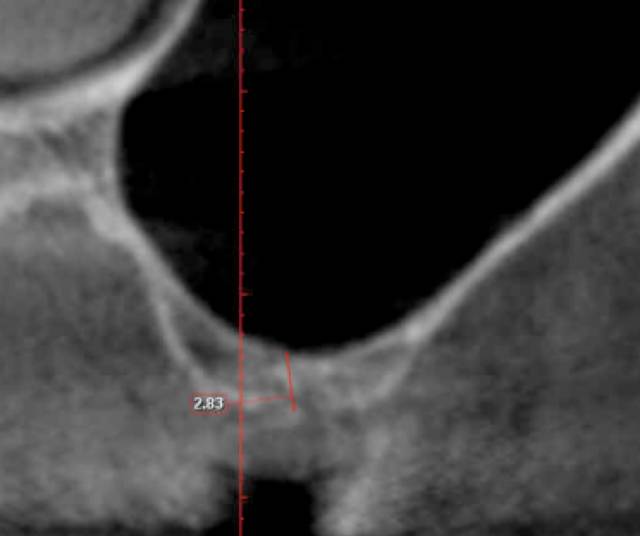 sinus aug c1 1