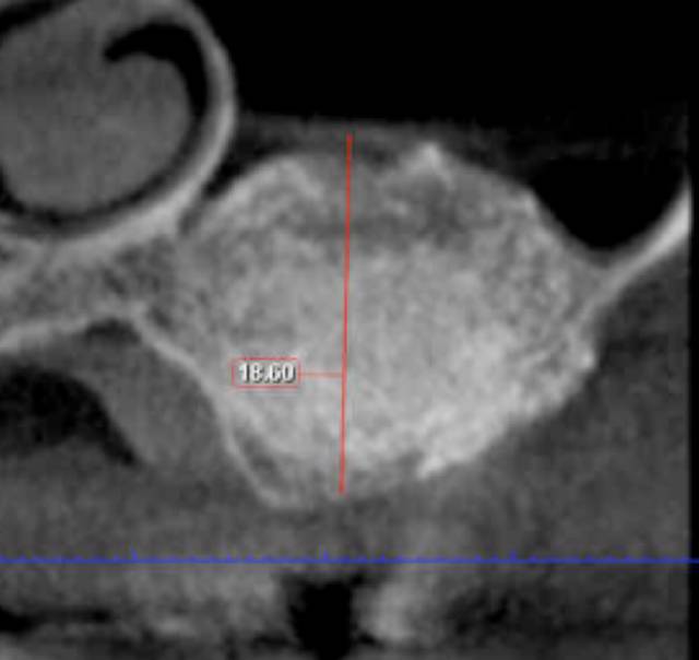 sinus aug c1 2