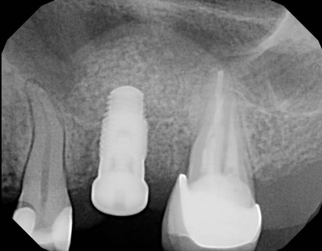 sinus aug c1 3